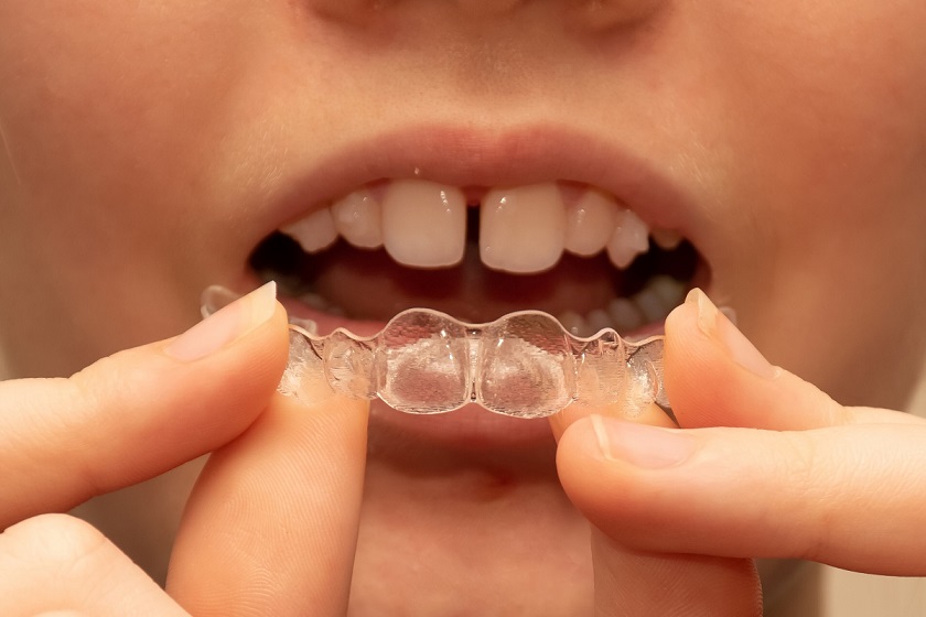 Teeth Gap Fillings - How to fill teeth gaps - Illusion Aligners